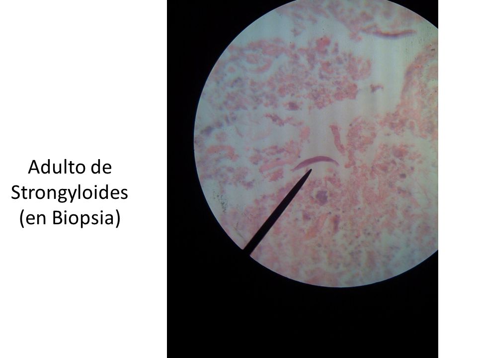 Adulto de Strongyloides (en Biopsia)