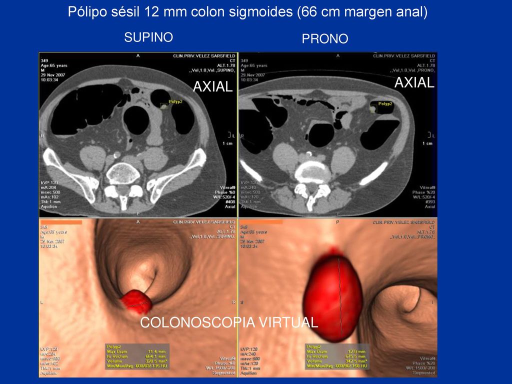 Pólipo sésil 12 mm colon sigmoides (66 cm margen anal)