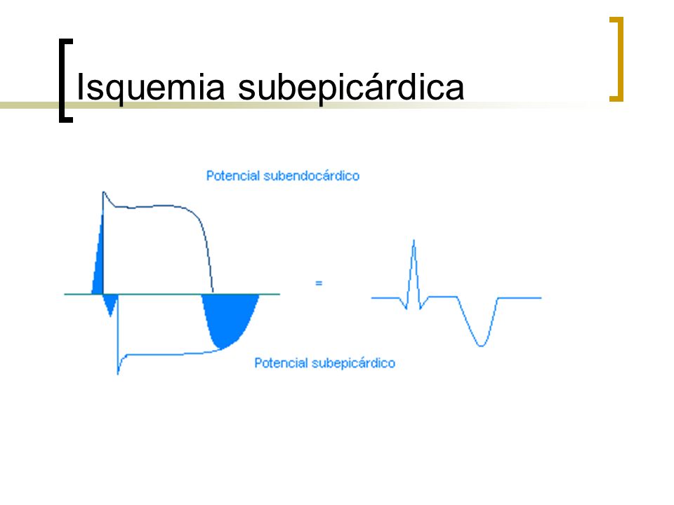 Isquemia subepicárdica
