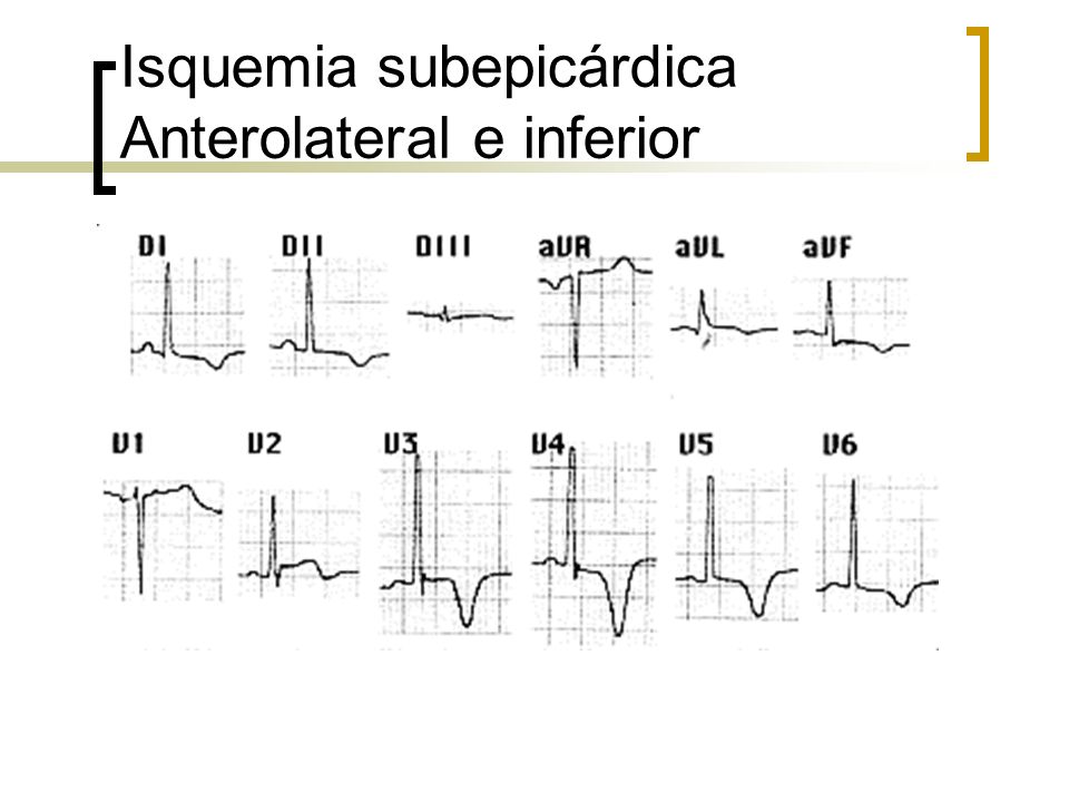Isquemia subepicárdica Anterolateral e inferior