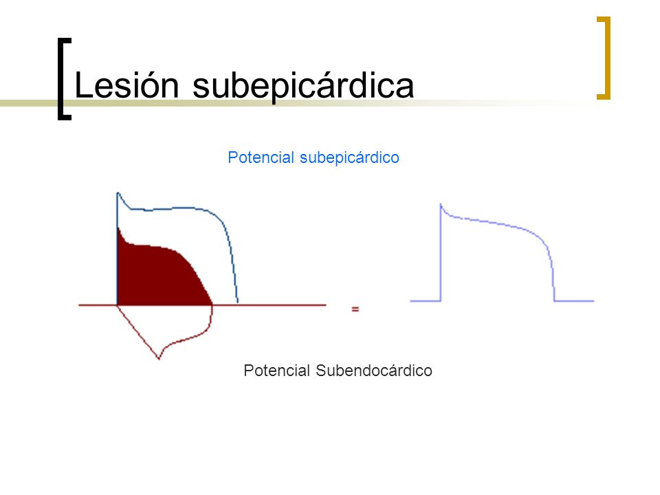 Lesión subepicárdica Potencial subepicárdico Potencial Subendocárdico
