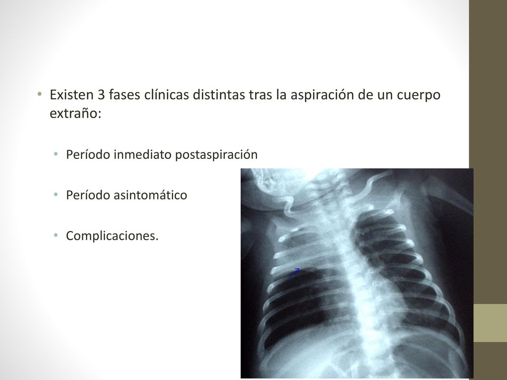 Existen 3 fases clínicas distintas tras la aspiración de un cuerpo extraño: