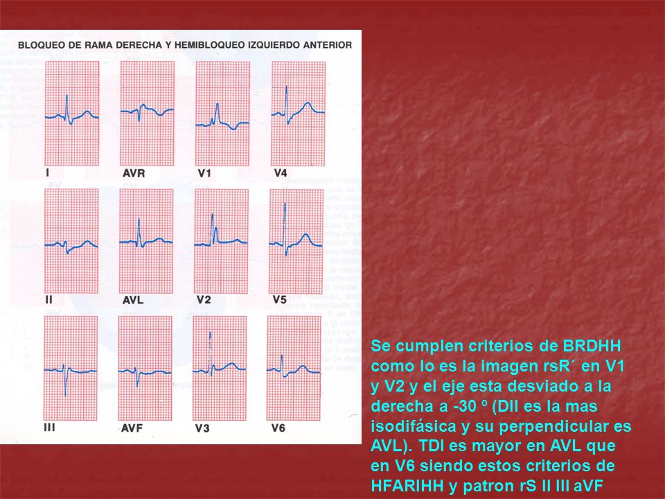 Se cumplen criterios de BRDHH como lo es la imagen rsR´ en V1 y V2 y el eje esta desviado a la derecha a -30 º (DII es la mas isodifásica y su perpendicular es AVL).