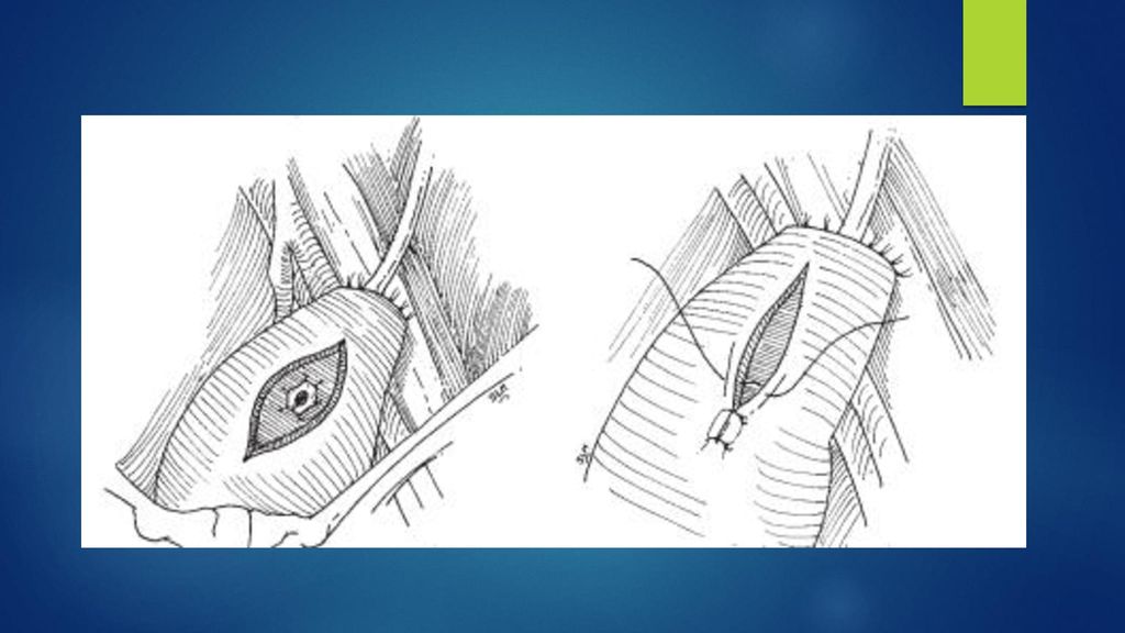 10. Se realiza anastomosis con puntos separados equidistantes con sutura absorbible 5/0 entre mucosa ureteral y vesical