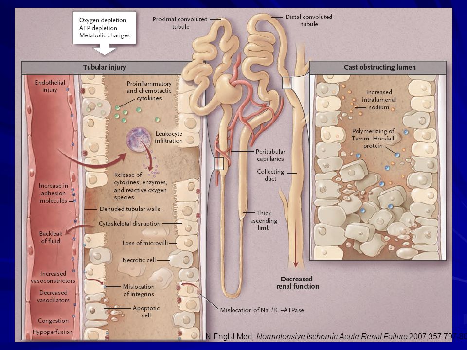 N Engl J Med, Normotensive Ischemic Acute Renal Failure 2007;357: