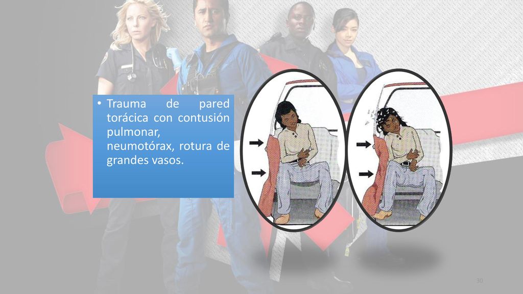 Trauma de pared torácica con contusión pulmonar, neumotórax, rotura de grandes vasos.