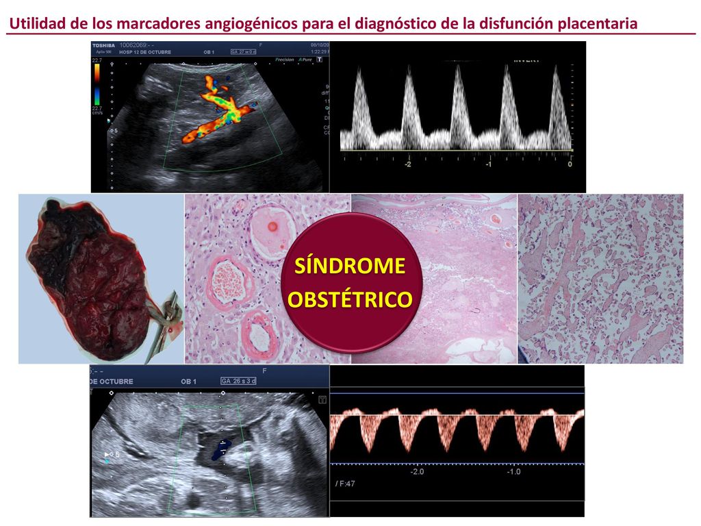 Utilidad de los marcadores angiogénicos para el diagnóstico de la disfunción placentaria