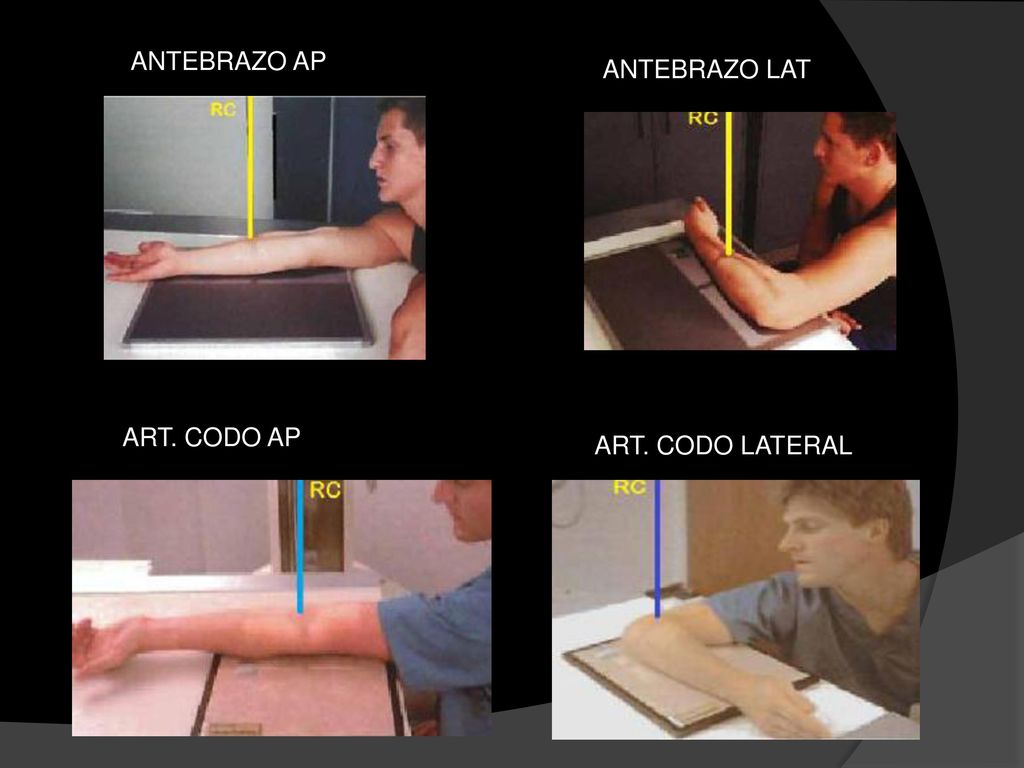 ANTEBRAZO AP ANTEBRAZO LAT ART. CODO AP ART. CODO LATERAL