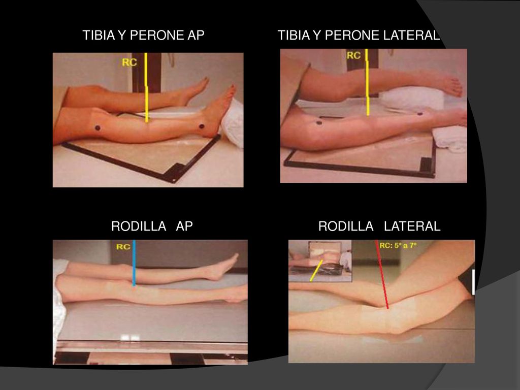 TIBIA Y PERONE AP TIBIA Y PERONE LATERAL RODILLA AP RODILLA LATERAL