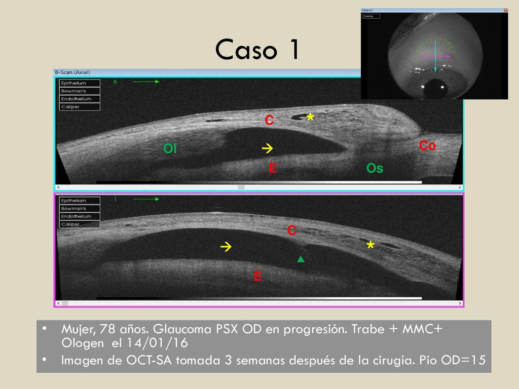 Caso 1 C. E. Ol. Os. Co. *  Mujer, 78 años. Glaucoma PSX OD en progresión. Trabe + MMC+ Ologen el 14/01/16.