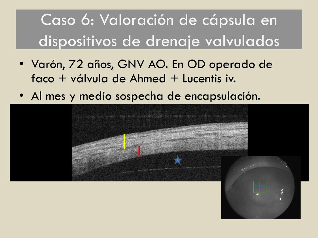 Caso 6: Valoración de cápsula en dispositivos de drenaje valvulados
