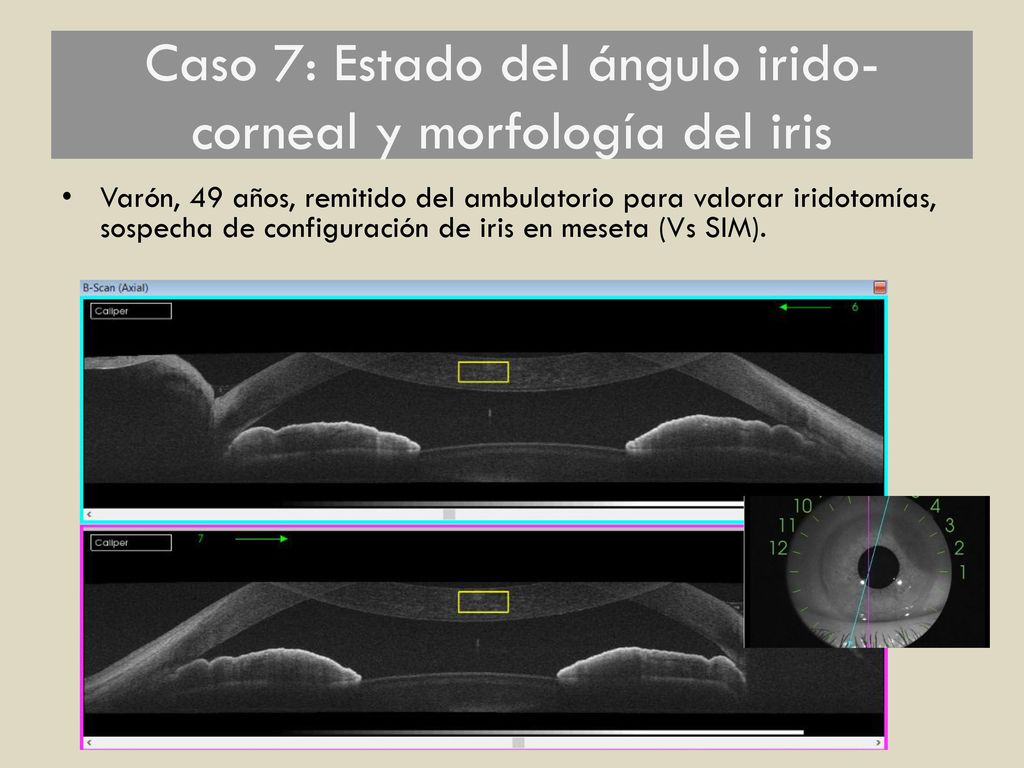 Caso 7: Estado del ángulo irido-corneal y morfología del iris