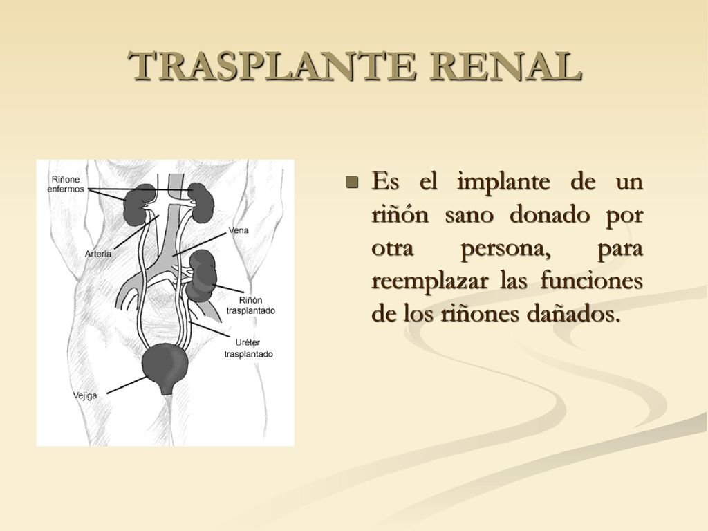TRASPLANTE RENAL Es el implante de un riñón sano donado por otra persona, para reemplazar las funciones de los riñones dañados.