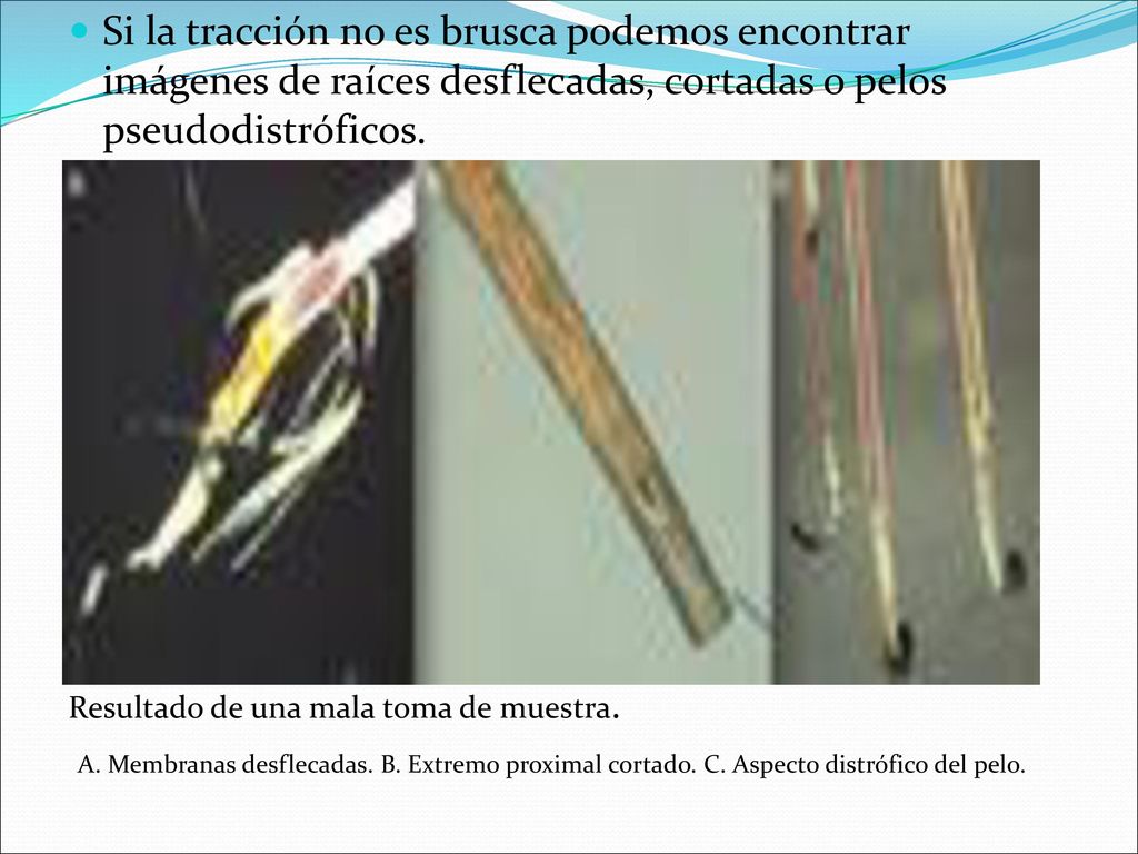 Si la tracción no es brusca podemos encontrar imágenes de raíces desflecadas, cortadas o pelos pseudodistróficos.