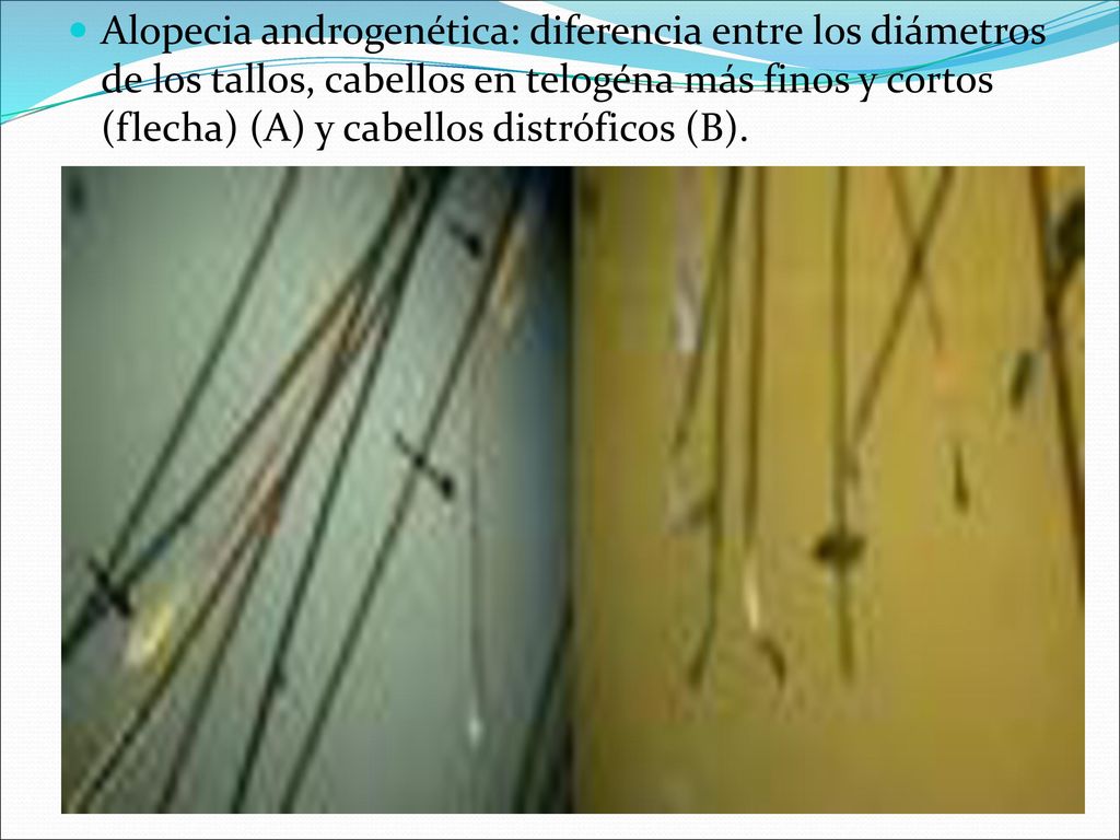 Alopecia androgenética: diferencia entre los diámetros de los tallos, cabellos en telogéna más finos y cortos (flecha) (A) y cabellos distróficos (B).