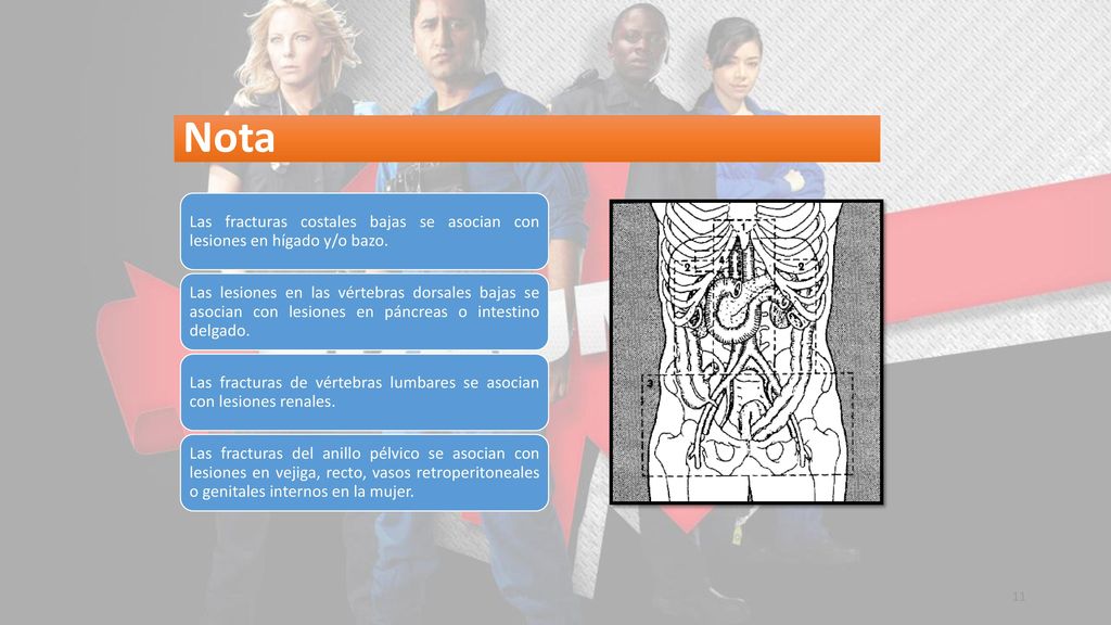 Nota Las fracturas costales bajas se asocian con lesiones en hígado y/o bazo.