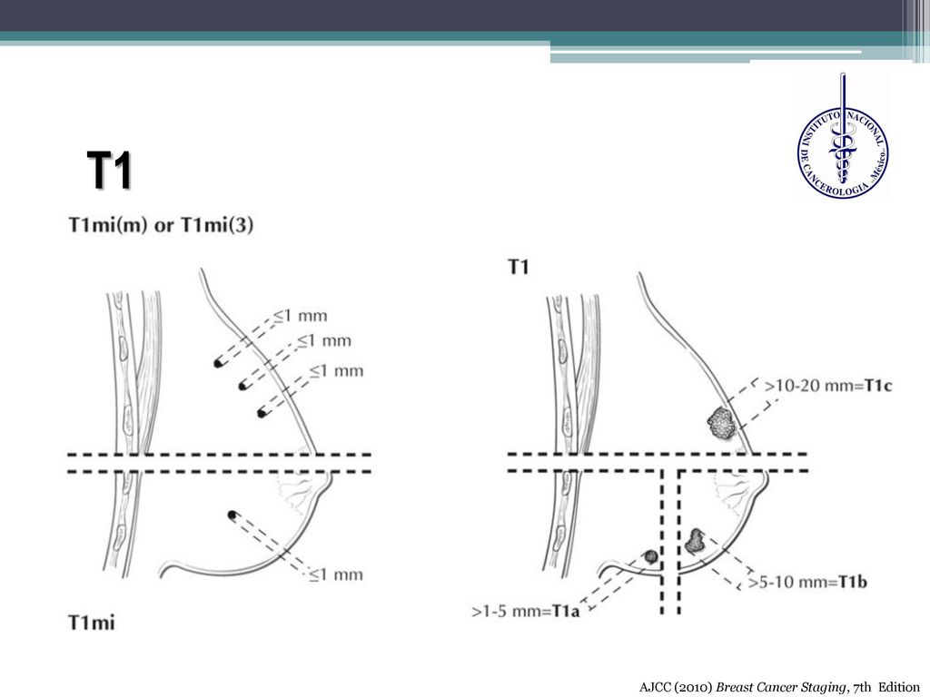 T1 AJCC (2010) Breast Cancer Staging, 7th Edition