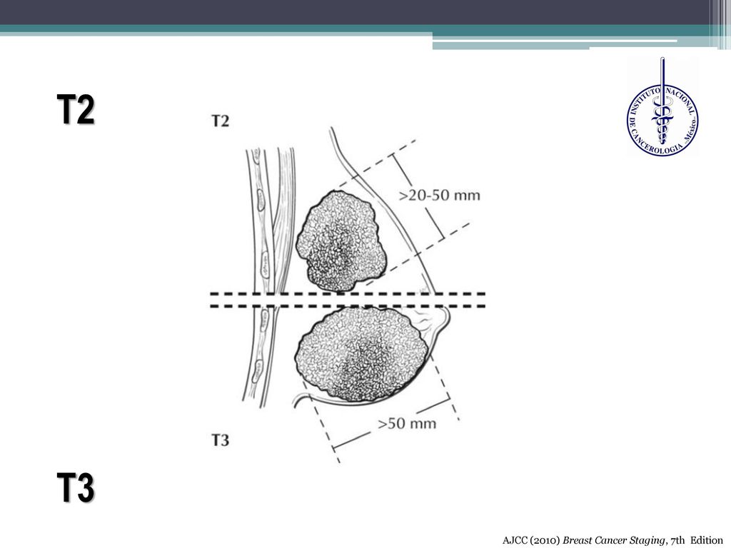 T2 T3 AJCC (2010) Breast Cancer Staging, 7th Edition