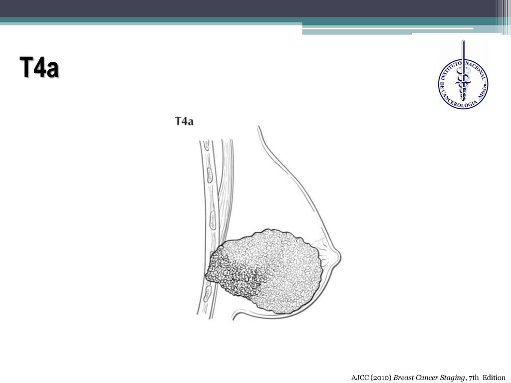 T4a AJCC (2010) Breast Cancer Staging, 7th Edition