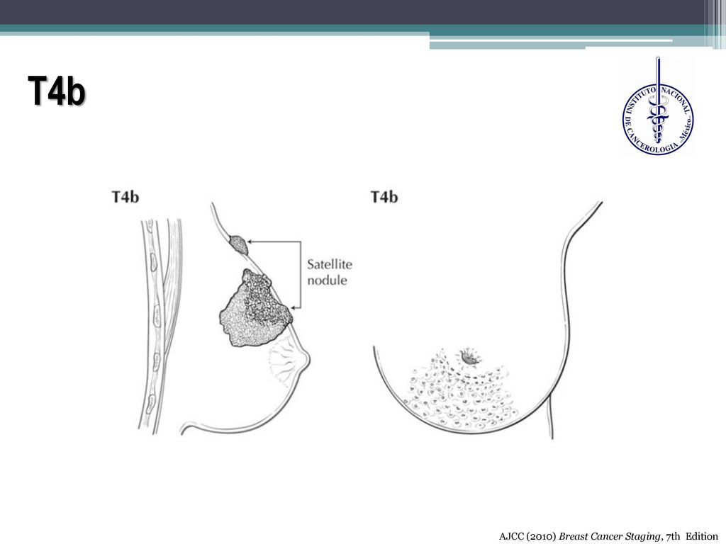 T4b AJCC (2010) Breast Cancer Staging, 7th Edition
