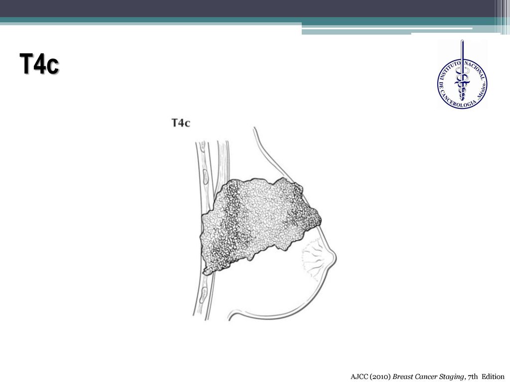 T4c AJCC (2010) Breast Cancer Staging, 7th Edition