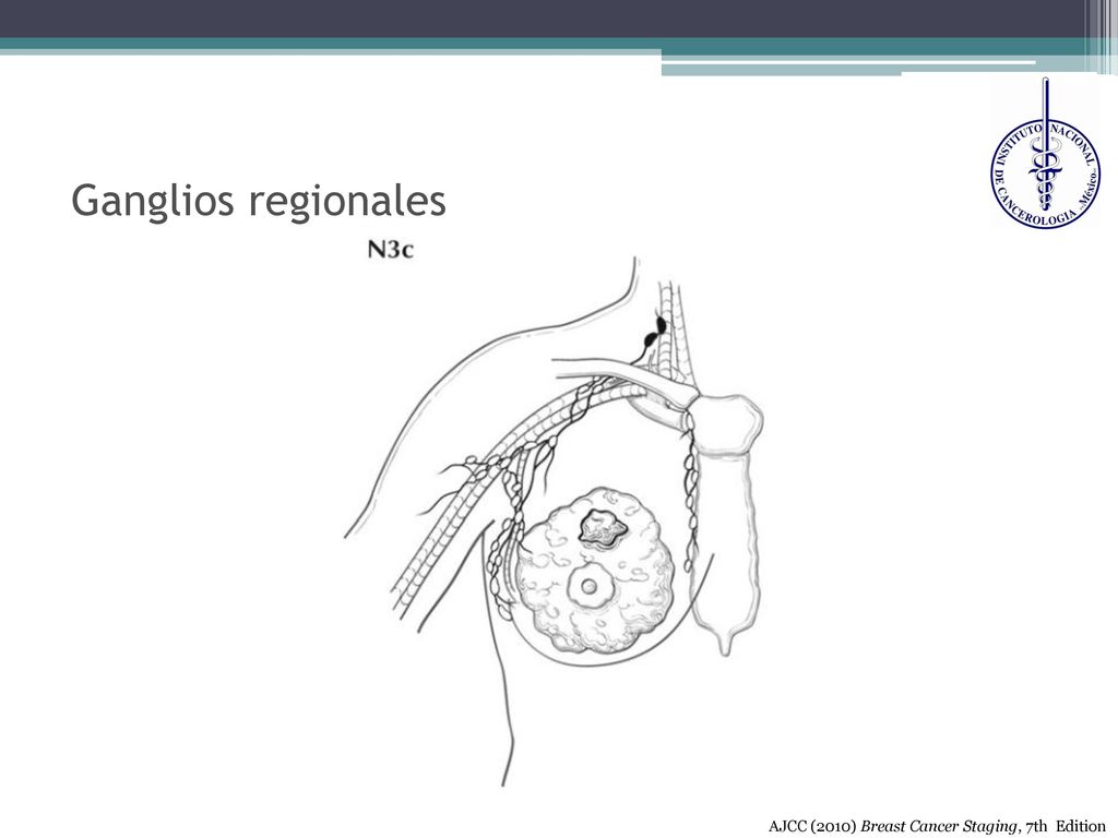 Ganglios regionales AJCC (2010) Breast Cancer Staging, 7th Edition