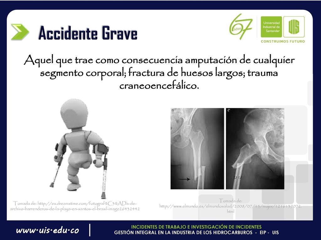 Accidente Grave Aquel que trae como consecuencia amputación de cualquier segmento corporal; fractura de huesos largos; trauma craneoencefálico.