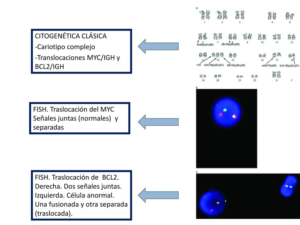CITOGENÉTICA CLÁSICA -Cariotipo complejo. -Translocaciones MYC/IGH y BCL2/IGH. FISH. Traslocación del MYC Señales juntas (normales) y separadas.