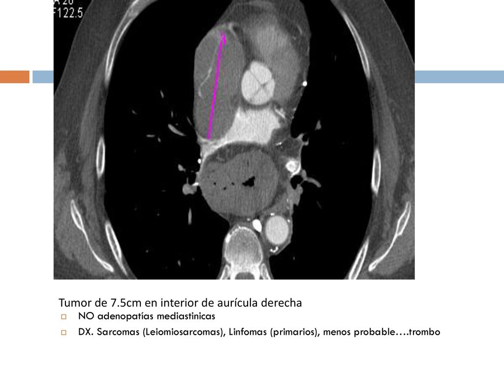 Tumor de 7.5cm en interior de aurícula derecha