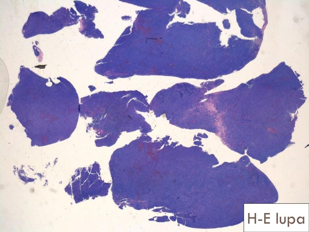 Fragmentos de borde irregular de tejido de aspecto linfoide, en sábana sin presencia de formación de folículos linfoides bien estructurados