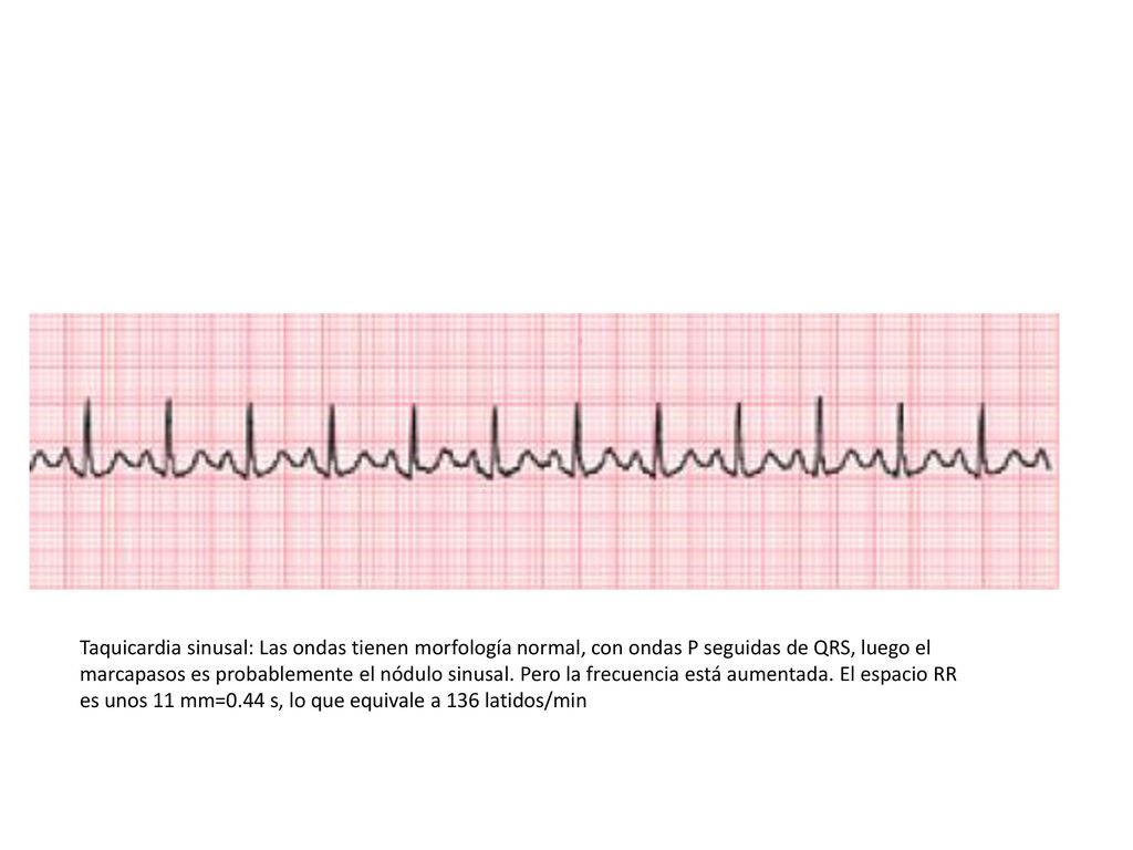 Taquicardia sinusal: Las ondas tienen morfología normal, con ondas P seguidas de QRS, luego el marcapasos es probablemente el nódulo sinusal. Pero la frecuencia está aumentada. El espacio RR es unos 11 mm=0.44 s, lo que equivale a 136 latidos/min