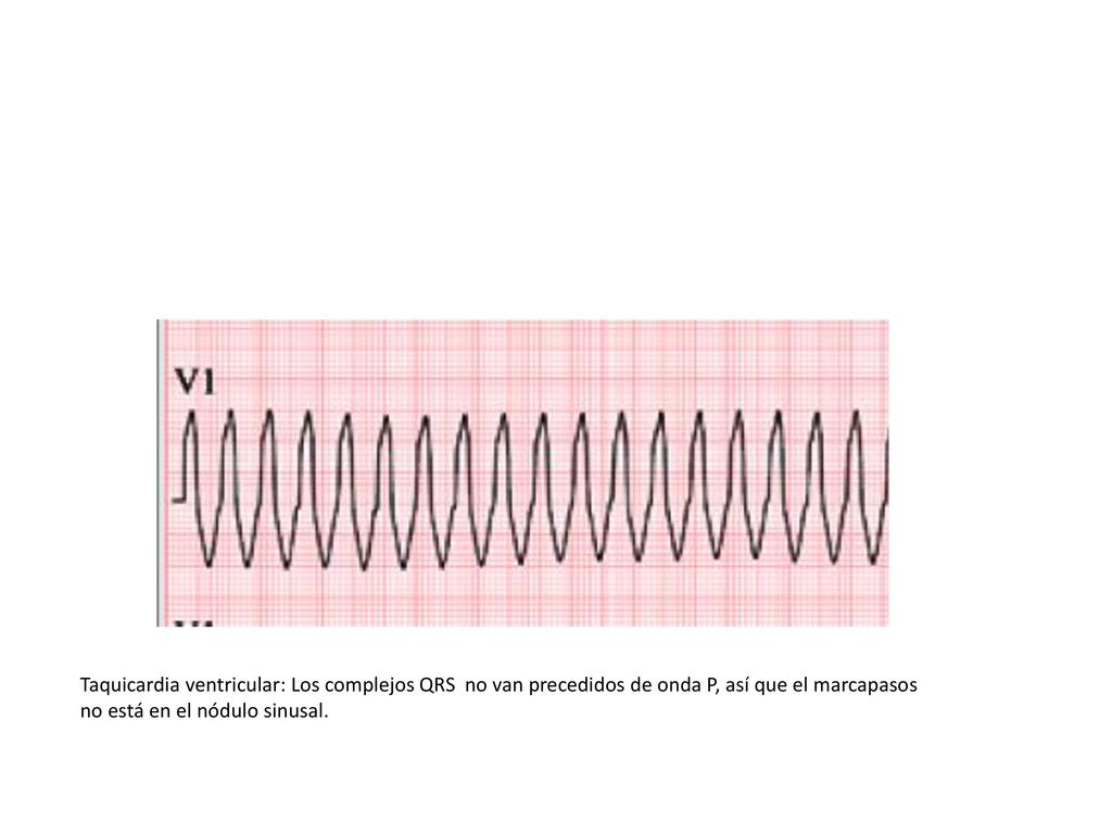 Taquicardia ventricular: Los complejos QRS no van precedidos de onda P, así que el marcapasos no está en el nódulo sinusal.
