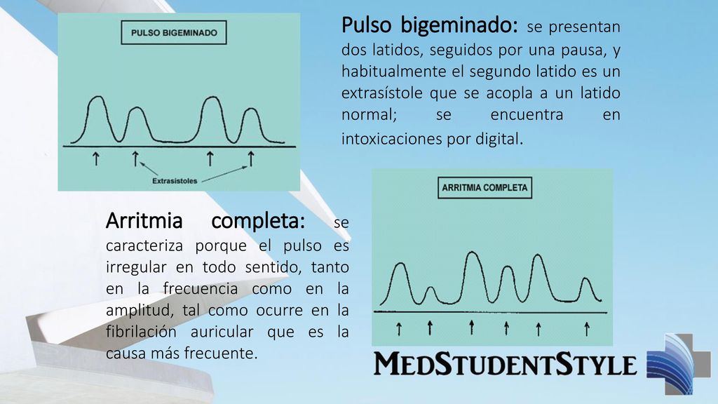 Pulso bigeminado: se presentan dos latidos, seguidos por una pausa, y habitualmente el segundo latido es un extrasístole que se acopla a un latido normal; se encuentra en intoxicaciones por digital.
