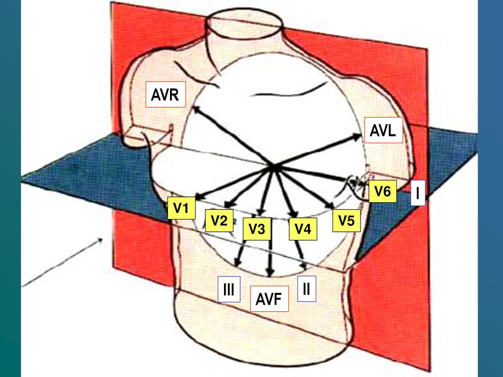 AVR AVL V6 I V1 V2 V5 V3 V4 III II AVF