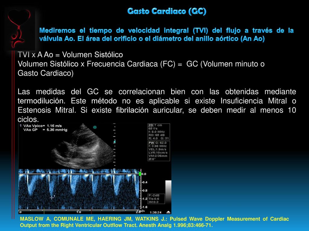 Gasto Cardiaco (GC) TVI x A Ao = Volumen Sistólico