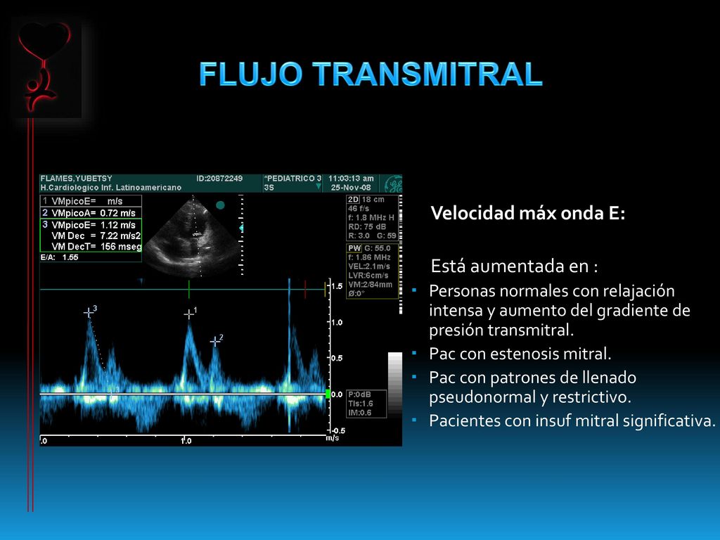FLUJO TRANSMITRAL Velocidad máx onda E: Está aumentada en :