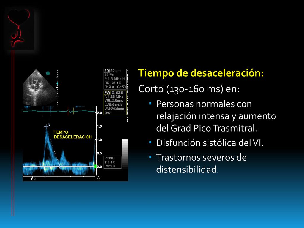 Tiempo de desaceleración: Corto ( ms) en: