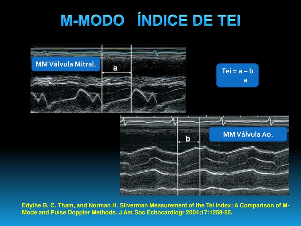 M-MODO ÍNDICE DE TEI MM Válvula Mitral. Tei = a – b a MM Válvula Ao.