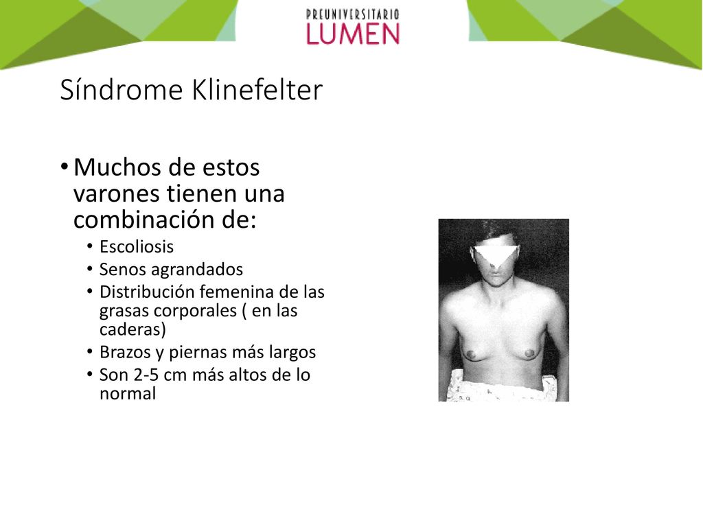 Síndrome Klinefelter Muchos de estos varones tienen una combinación de: Escoliosis. Senos agrandados.