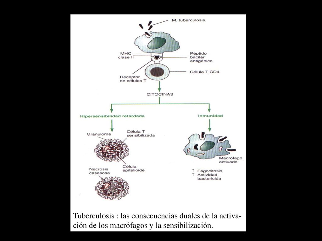 Tuberculosis : las consecuencias duales de la activa- ción de los macrófagos y la sensibilización.