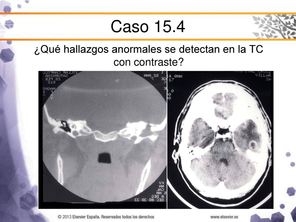 ¿Qué hallazgos anormales se detectan en la TC con contraste