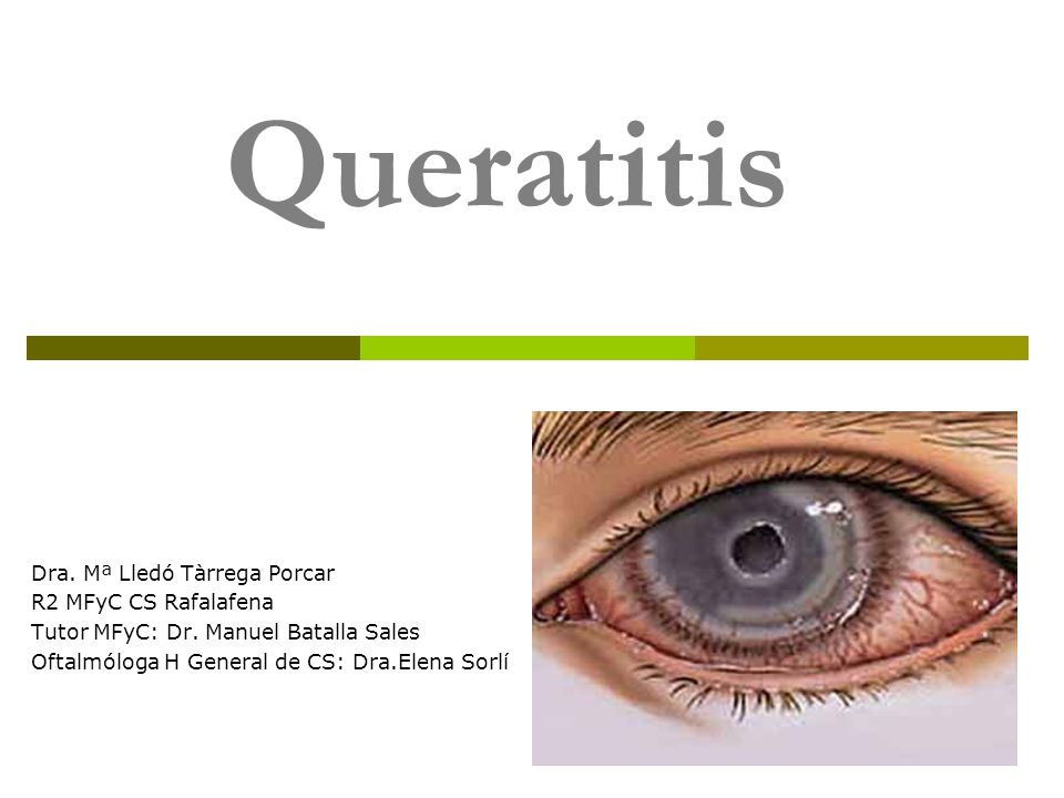 Queratitis Dra. Mª Lledó Tàrrega Porcar R2 MFyC CS Rafalafena