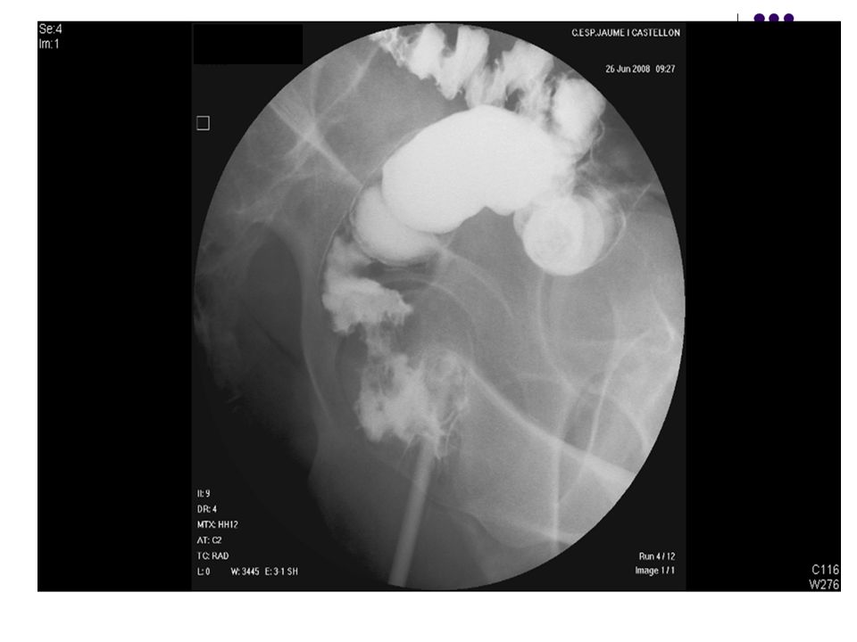 ENEMA OPACO: Se informó como lesión estenosante localizada a 4 cm del margen anal, compatible con neoplasia.