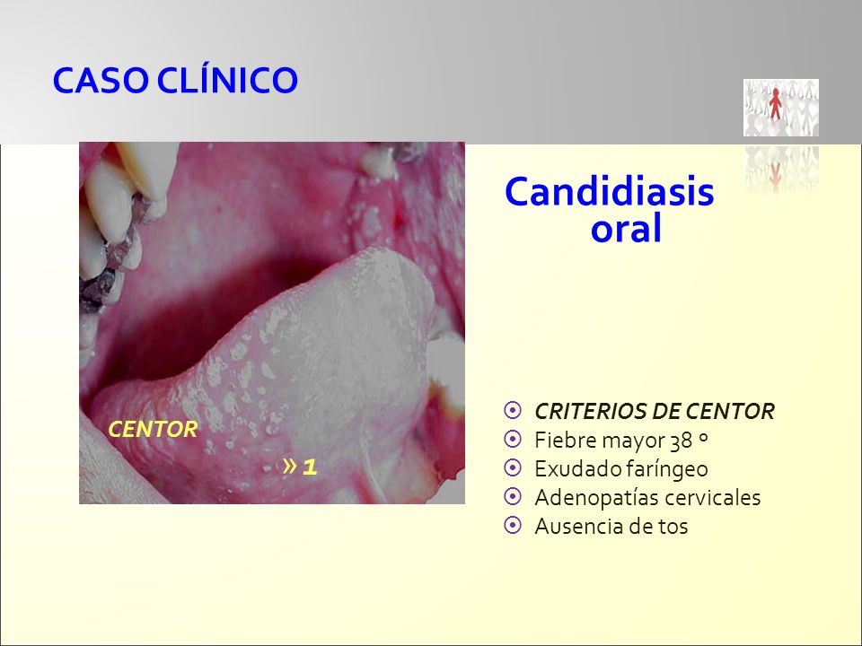 Candidiasis oral CASO CLÍNICO 1 CRITERIOS DE CENTOR Fiebre mayor 38 º