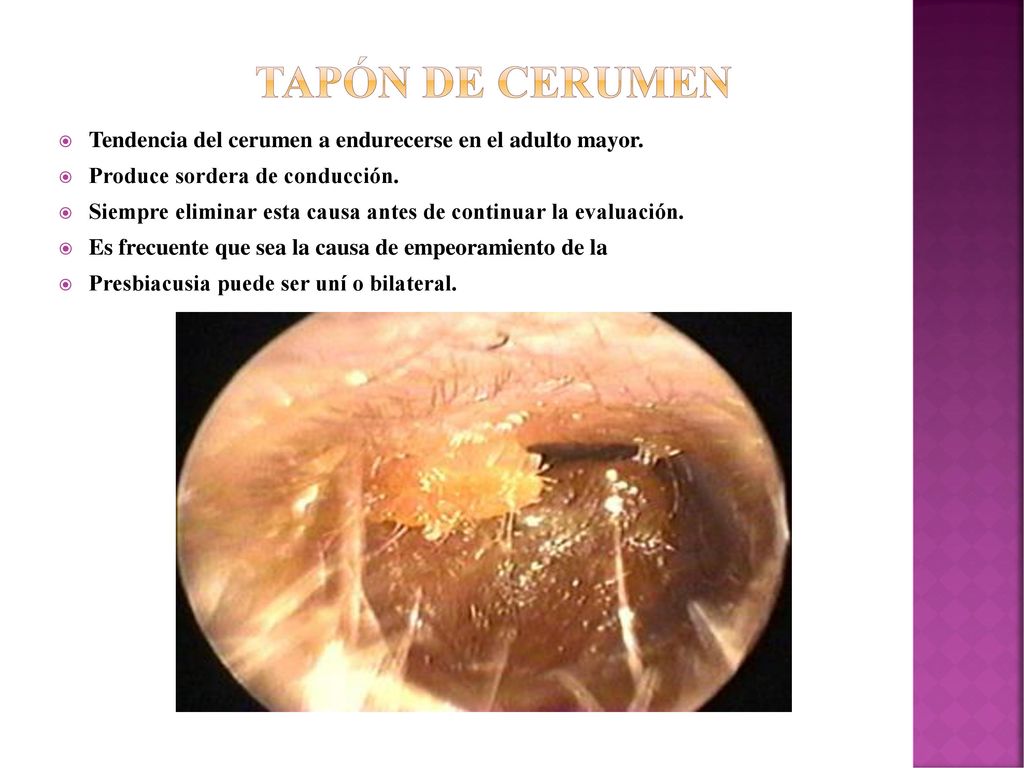 Tapón de cerumen Tendencia del cerumen a endurecerse en el adulto mayor. Produce sordera de conducción.