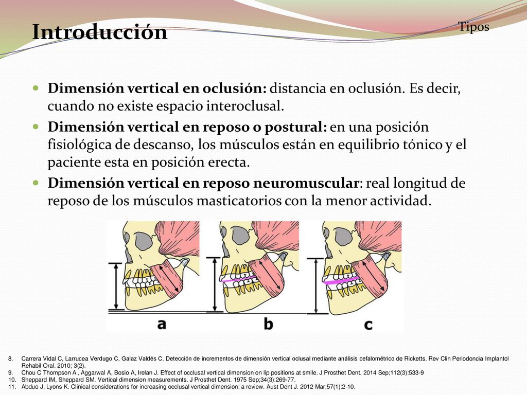 Introducción Tipos. Dimensión vertical en oclusión: distancia en oclusión. Es decir, cuando no existe espacio interoclusal.