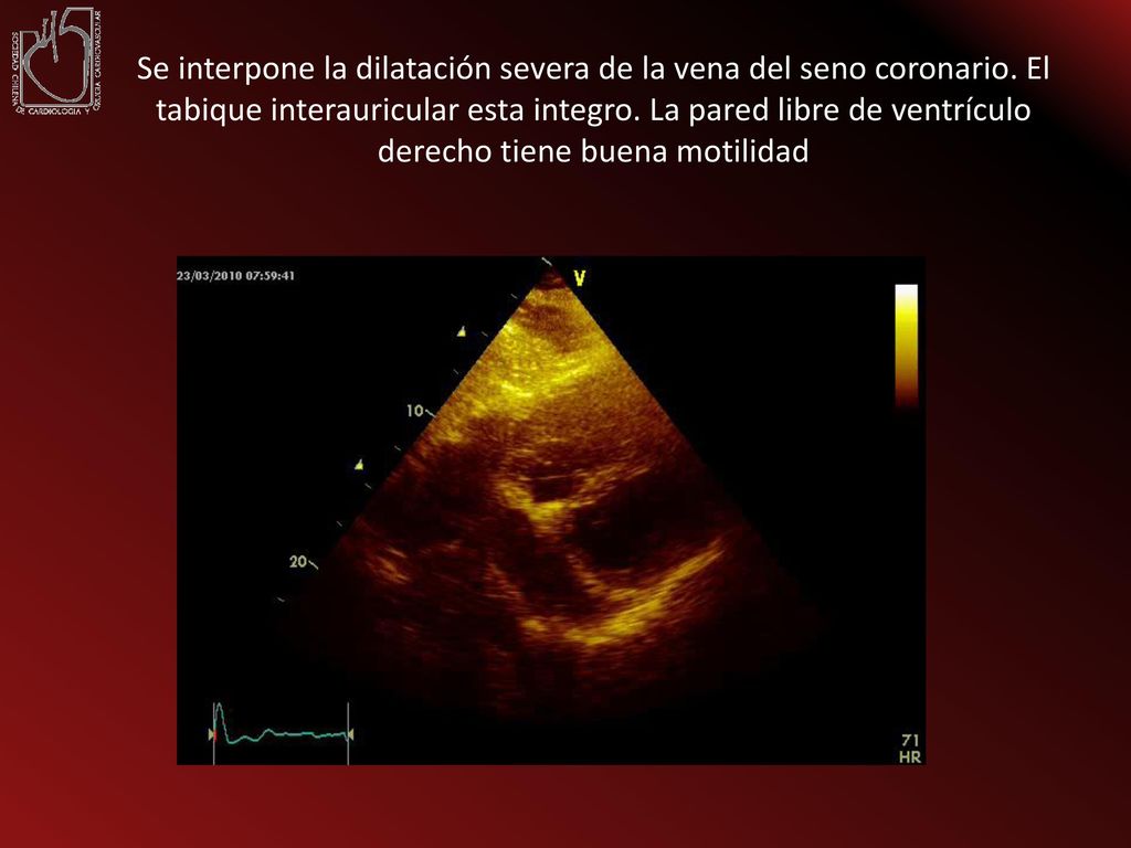 Se interpone la dilatación severa de la vena del seno coronario