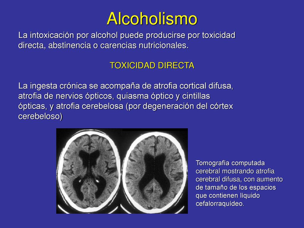 Alcoholismo La intoxicación por alcohol puede producirse por toxicidad