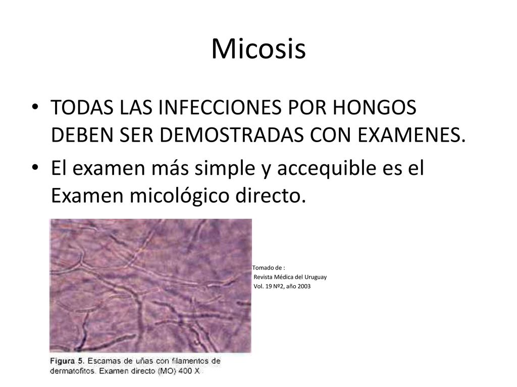 Micosis TODAS LAS INFECCIONES POR HONGOS DEBEN SER DEMOSTRADAS CON EXAMENES. El examen más simple y accequible es el Examen micológico directo.