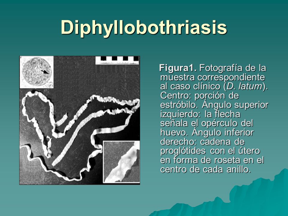 Diphyllobothriasis teniasis - Galandféreg-fertőzés - Diphyllobothriasis fórum